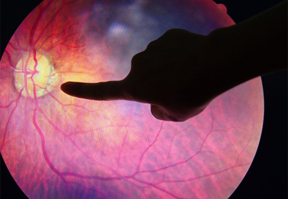 Deslocamento de retina: fique atento aos sinais