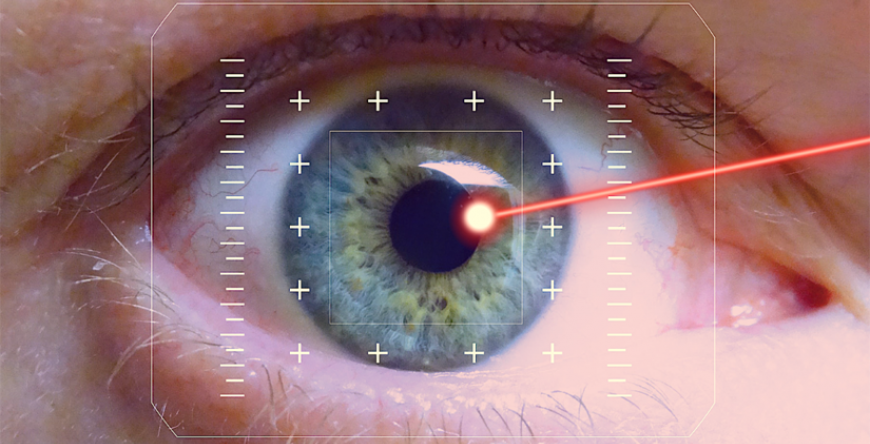 IRIDOTOMIA A LASER